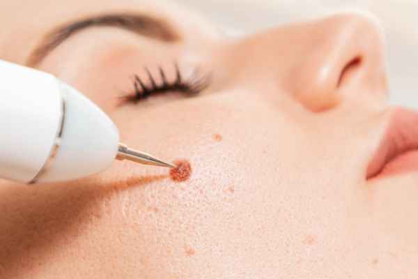 CryoPen: 5 Skin Concerns It May Be Used to Treat 3 What actually happens during a CryoPen treatment Rhyl?