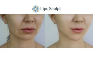 Explaining Total Skin Tightening Treatment And What It Can Do For You 2 Do you want to boost your self confidence? Give Morpheus8 Rhyl a try today!