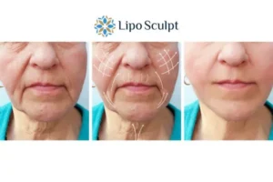 Explaining Total Skin Tightening Treatment And What It Can Do For You 3 Boost your confidence with Morpheus8 Rhyl call our team today!