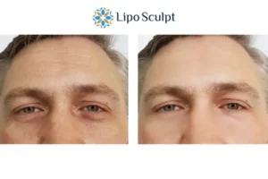 Explaining Total Skin Tightening Treatment And What It Can Do For You 6 Morpheus8 Rhyl book in today to find out more!