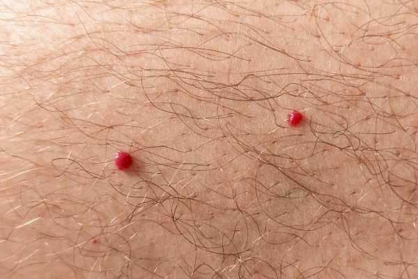 CryoPen: 5 Skin Concerns It May Be Used to Treat 2 cherry angioma removal Rhyl