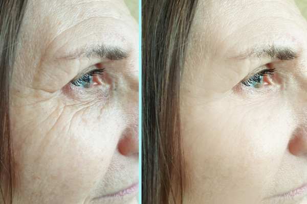 Why Do People Choose HIFU for a Non-Surgical Facelift? 4 How long can HIFU results last Rhyl?