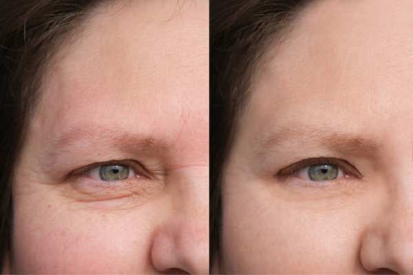 HIFU vs Botulinum Toxin: Understanding the Differences 4 How long do HIFU results last Rhyl?