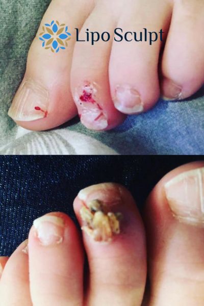Wart removal customer results from Lipo Sculpt Rhyl